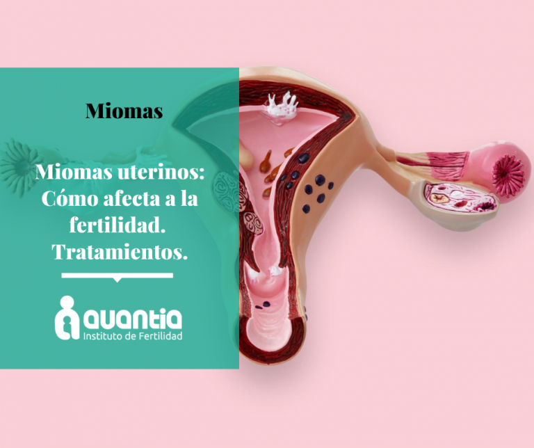 Miomas Uterinos Y Su Relación Con La Fertilidad Clínica De Fertilidad Avantia