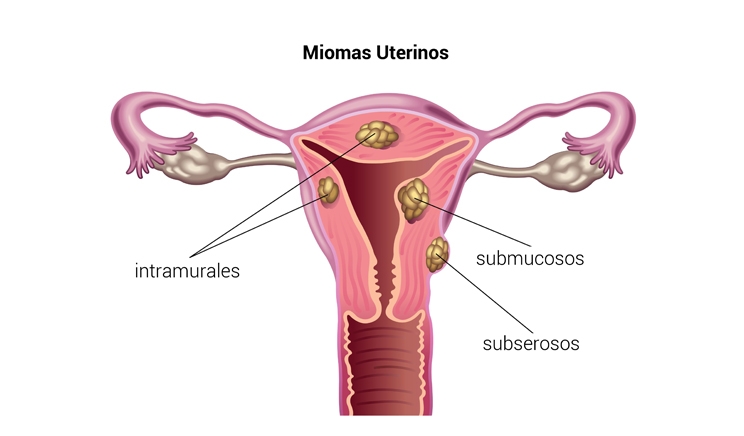 Miomas uterinos